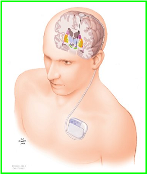 ECP 1